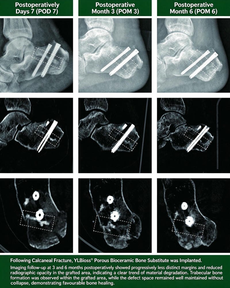 Calcaneal fracture clinical imaging